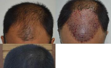 Hair transplantation surgery before and after photos