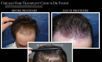 Hair restoration procedure before and after results