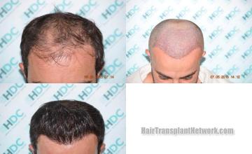 Hair transplantation surgery before and after photos