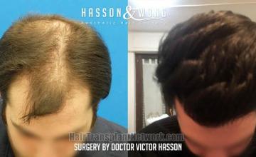 Hair restoration procedure before and after result photos