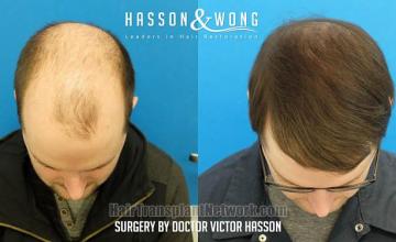 Before and after hair transplant procedure images