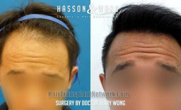 Hair transplantation surgery before and after images