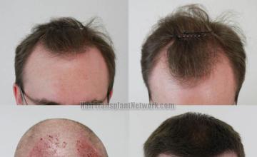 Hair transplantation surgery before and after images