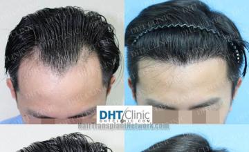 Hair transplantation procedure before and after results