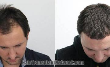 Before and after hair restoration procedure images