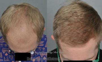 Before and after hair restoration procedure images