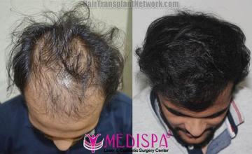 Before and after hair restoration procedure images