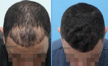 Before and after hair restoration procedure images