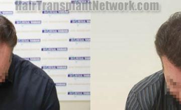 Hair transplantation surgery before and after photos