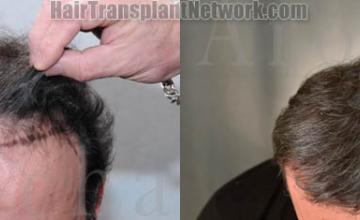 Hair transplantation surgery before and after photos