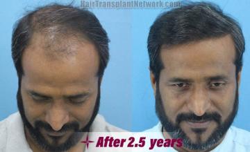 Hair transplantation surgery before and after images