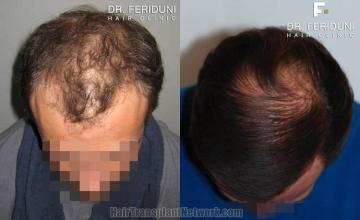 Hair transplantation surgery before and after pictures