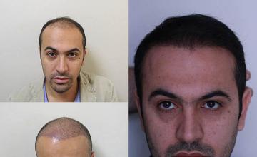 Hair transplantation surgery before and after images