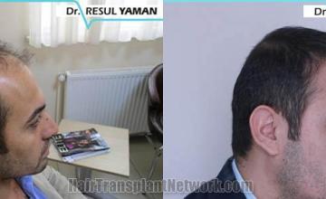 Hair restoration procedure before and after pictures