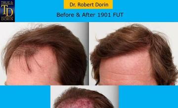 Hair restoration procedure before and after pictures