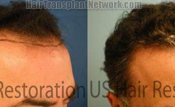 Right view before and after hair replacement surgery photos