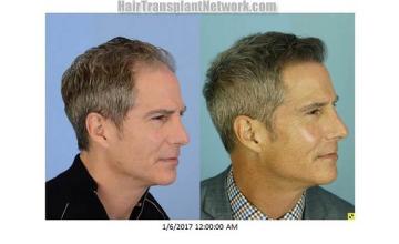 Hair transplantation surgery before and after images