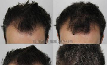 Hair restoration procedure before and after results