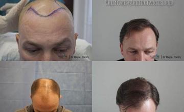 Top view - Before and after surgical hair replacement