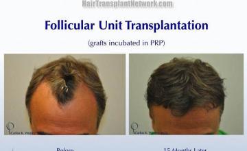 Top view before and after hair restoration results