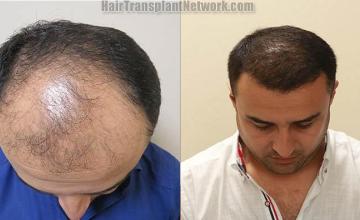 Hair restoration procedure before and after pictures