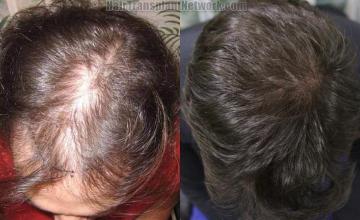 Hair transplantation surgery before and after images