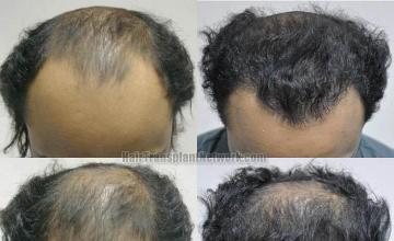 Before and after hair transplant procedure images