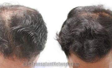 Hair transplantation surgery before and after photos