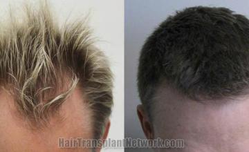 Hair transplantation surgery before and after images