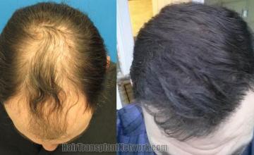 Top view - Before and after surgical hair replacement