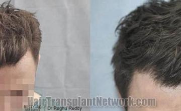 Top view - Before and after surgical hair replacement