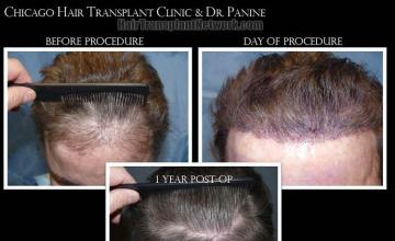 Hair transplantation surgery before and after photos