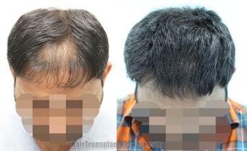 Hair transplantation surgery before and after images