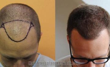 Hair transplantation surgery before and after photos