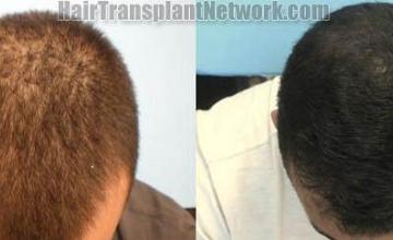 Hair transplantation surgery before and after images