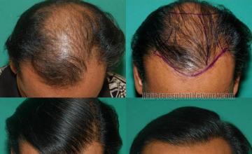 Before and after hair restoration procedure images