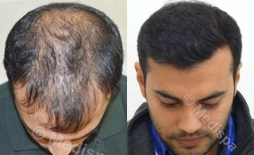 Hair restoration procedure before and after photo results