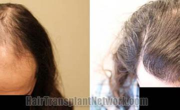 Top view - Before and after hair restoration procedure