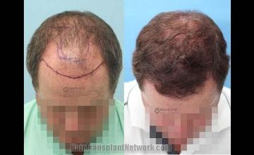 Hair transplantation surgery before and after images