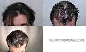 Hair transplantation surgery before and after images