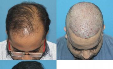 Before and after hair restoration procedure images