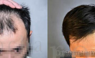 Before and after hair restoration procedure images