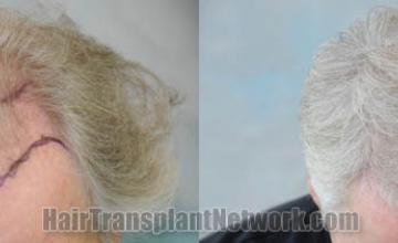 Hair transplantation surgery before and after images