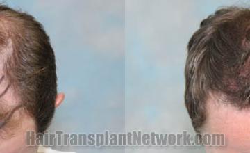 Before and after hair restoration procedure images