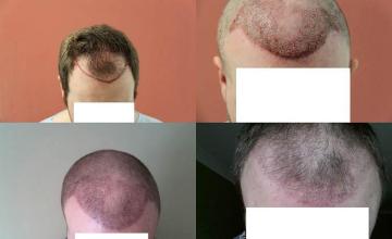 Hair restoration procedure before and after results