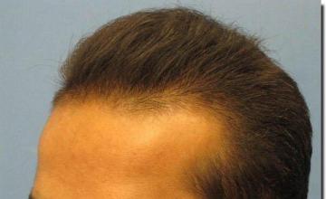 Hair restoration procedure results