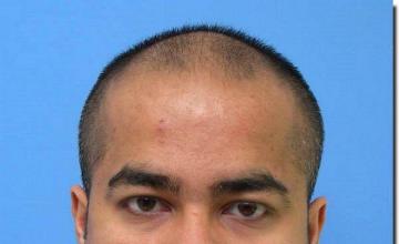 Hair restoration procedure results