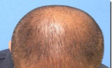 Hair restoration procedure results