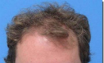 Hair restoration procedure results