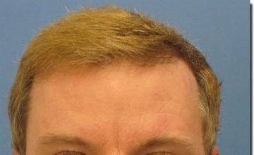 Hair restoration procedure results